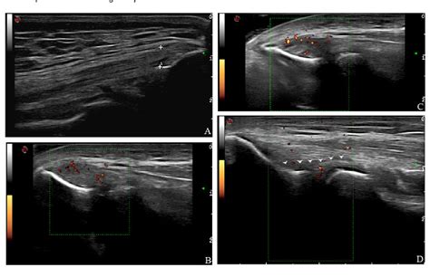 Ultrasound discloses entheseal involvement in... : Rheumatology